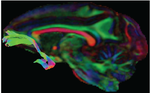 Longitudinal effects of early social adversity on brain and behaviour